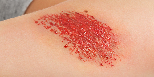 Nahaufnahme einer roten Schürfwunde oder Abrasion auf heller Haut. Nahaufnahme einer roten Schürfwunde oder Abrasion auf heller Haut.